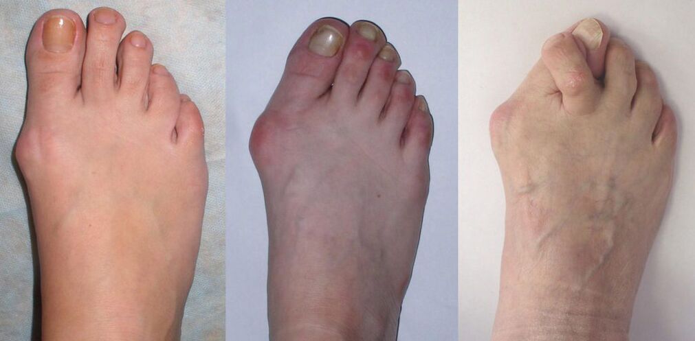 Arthrite des pieds