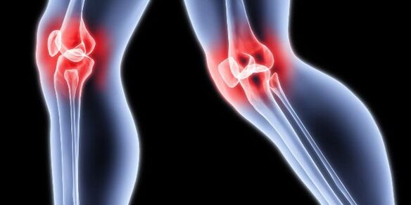 Arthrose du genou