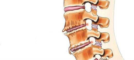 Qu'est-ce que la spondylose