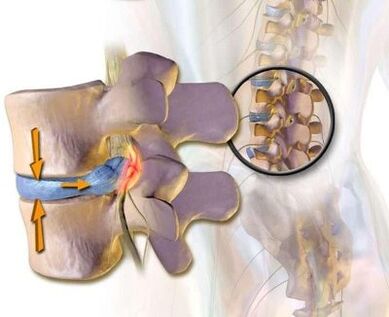 Syndrome brun vasculaire