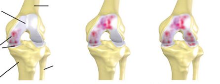 degré d'arthrose