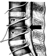 Image x-ray du département lombaire de l'ostéochondose