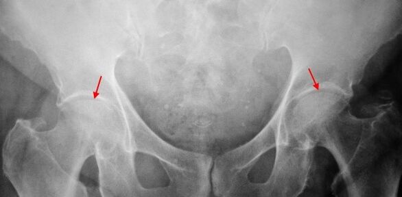 Coksartrose à double façade qui soutiennent l'écart articulaire, la sclérose des surfaces articulaires