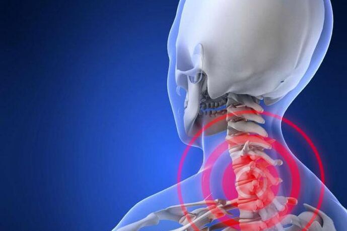 La douleur lancinante au cou est un symptôme précoce de l'ostéochondrose cervicale