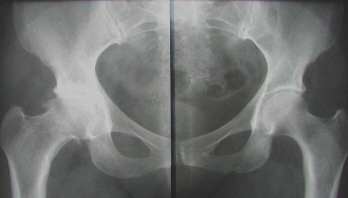 Radiographie de l'articulation de la hanche touchée par l'arthrose